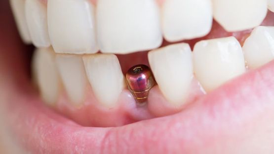 A patient with a dental implant